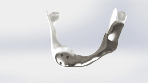 First Successful Operation With Custom 3D-Printed Titanium Lower Jaw